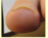 【足の指の痛みは巻き爪が原因？】巻き爪について説明します。